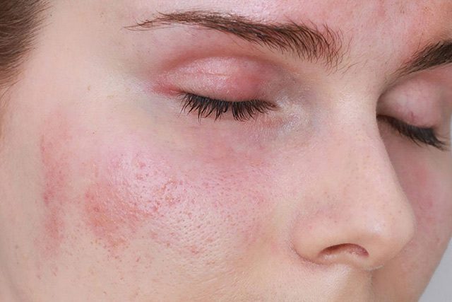 Tình trạng da bị kích ứng với kem chống nắng xuất phát từ nhiều nguyên nhân khác nhau