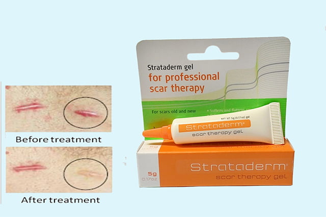 Strataderm là sản phẩm điều trị mờ sẹo, tàn nhang và nám cực kỳ hiệu quả